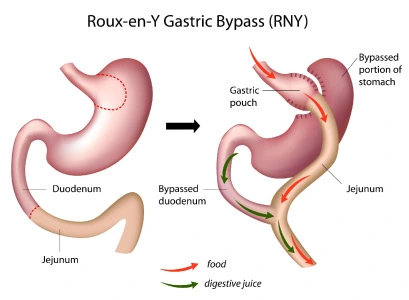 Roux-en-Y-Gastric-Bypass